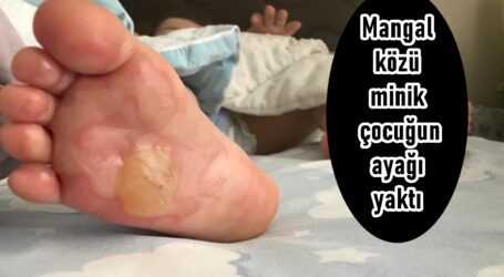 Mangal közü minik çocuğun ayağı yaktı